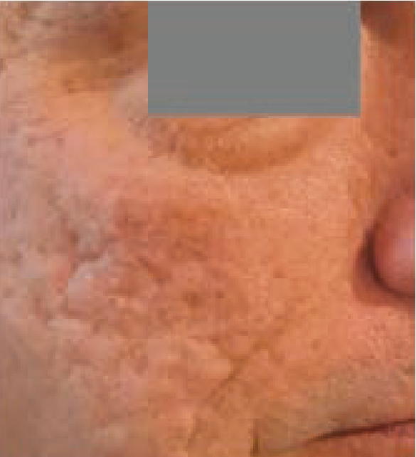 Antes