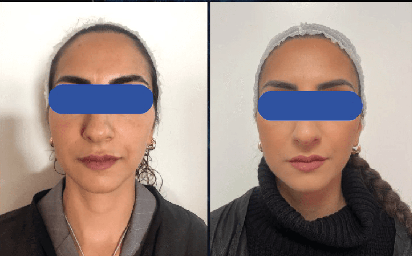 Antes y Después 5